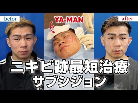 【ニキビ跡治療】サブシジョンをやったら効果ありすぎた